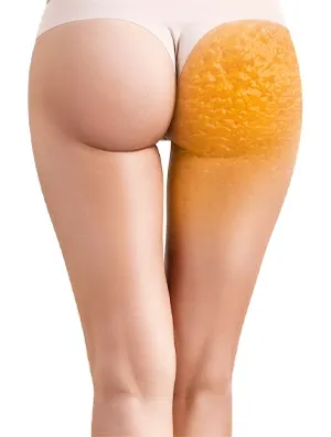 Vitamins that Help Remove Cellulite