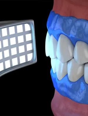 Different Types Of Teeth Whitening Kits